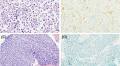 Assessment of BRAF V600E (VE1) immunochemistry for the detection of BRAF V600E mutation in non–small cell lung carcinoma cytology specimens