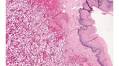 Vaginal Bleeding as Initial Presentation of an Aggressive Renal Cell Carcinoma: A Case Report and Review of the Literature
