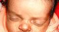 CENTRO-FACIAL PIGMENTATION IN ASYMPTOMATIC CONGENITAL CHIKUNGUNYA VIRAL INFECTION