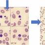 Hereditary red cell defects as an underrecognized cause of neonatal jaundice