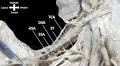 A Unique Presentation of an Upper Subscapular Nerve Variation Accompanied by an Accessory Subscapular Artery