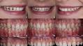 Enhancing Esthetics With Digital Dentistry: A 2‐Year Follow‐Up of 3D‐Printed Restorations
