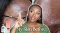 Dimma Umeh Reveals 5 Cleansers Every Black Woman With Acne Should Try