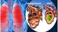 ATS/ESICM/SCCM Guidelines on Management of ARDS in Adults