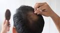 Mallia Aesthetics Completes Regulatory Milestones for Novel sCD83-Based Hair Growth Technology