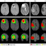 Enhanced brain tumor segmentation in medical imaging using multi-modal multi-scale contextual aggregation and attention fusion