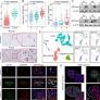 MS4A4A promotes macrophages M2 polarization via NF-κB /JAK-STAT6 axis, resulting GBM malignant progression