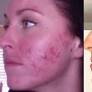 This Blogger Swears That She Conquered Her Cystic Acne With a Laser