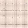 Ranolazine Toxicity Secondary to Paxlovid