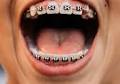 Are Metal Braces Back? The Triumphant Return of ‘Tinsel Teeth’