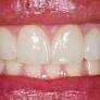 Dentists share more thoughts on the Miss Thailand viral veneer moment