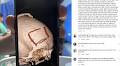 "They Peeled Off My Face": World Surf Champ Reveals Secret Brain Surgery