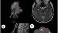 Case Report: A Rare Case of Nasal Forehead Mass in Kimura's Disease