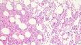 Hemophagocytic lymphohistiocytosis and myopericarditis induced by campylobacter: a case report