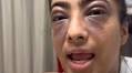 I had a ‘life-threatening allergic reaction’ — I filmed a TikTok instead of using my EpiPen