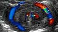 Imaging Review of Intestinal Malrotation and Midgut Volvulus