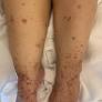 Carbamazepine-induced Stevens-Johnson syndrome in a patient with history of methotrexate-induced mast cell activation syndrome