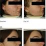 New clinical approach in facial mild–moderate acne: Re-stabilization of skin microbiota balance with a topical biotechnological phytocomplex