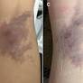 Combined Laser Therapy for Post-sclerotherapy Hyperpigmentation Following Nicolau Syndrome: A Case Report