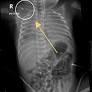 Serendipitous Discovery: A Case of Twin Congenital Pseudarthrosis of the Clavicle in Saudi Arabia and Literature Review