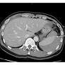 Hemoperitoneum due to Splenic Laceration Caused by Colonoscopy: A Rare and Catastrophic Complication