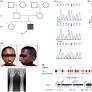 The E262K mutation in Lamin A links nuclear proteostasis imbalance to laminopathy-associated premature aging