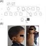 Genome sequencing identifies a large non-coding region deletion of SNX10 causing autosomal recessive osteopetrosis