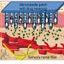 Glassy carbon microneedles—new transdermal drug delivery device derived from a scalable C-MEMS process
