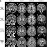 Homozygous EPRS1 missense variant causing hypomyelinating leukodystrophy-15 alters variant-distal mRNA m