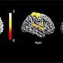 Conceptual disorganization and redistribution of resting-state cortical hubs in untreated first-episode psychosis: A 7T study