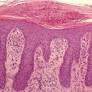 A Novel Approach to the Treatment of Pembrolizumab-induced Psoriasis Exacerbation: A Case Report