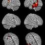 Distinct neurophysiology during nonword repetition in logopenic and non-fluent variants of primary progressive aphasia