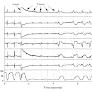 An Experimental Model of Sudden Death Due to Low-Energy Chest-Wall Impact (Commotio Cordis)