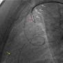 The retrograde approach to coronary chronic total occlusion interventions