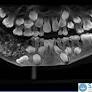 India, estratti 526 denti dalla bocca di un bambino di 7 anni