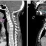 Supraglottic Myxedema Presenting as a Complication of Hypothyroidism: A Case Report
