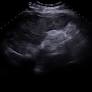 Acute Chest Syndrome Masquerading As Sepsis: A Rare Presentation of Sickle Cell Anemia Complication