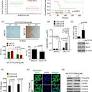 Deficiency of CCN5/WISP-2-Driven Program in breast cancer Promotes Cancer Epithelial cells to mesenchymal stem cells and Breast Cancer growth