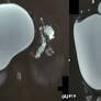 Giant choledochal cyst: The largest reported! - Biswas - 2023 - Clinical Case Reports