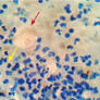 Insulin injection site abscess caused by Mycobacterium fortuitum - Singha - 2017 - Practical Diabetes