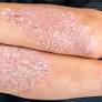 Stressful Family Changes in Early Childhood Could Increase Psoriasis Risk