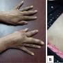 Delayed Diagnosis of a Rare Case of Melorheostosis Affecting Both Upper Limbs