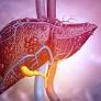 Cirrhosis Tied to Poor Outcomes in the Months After PCI