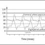 Jugular Venous C-V Wave in Severe Tricuspid Regurgitation