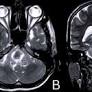 Stroke Mimicry: Unmasking a Brainstem Tuberculoma in a Young Patient - Palanisamy - 2025 - Clinical Case Reports