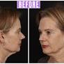 Retired Teacher, 68, Brought to Tears by Stunning Facelift Results