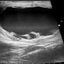 Torsion of Epididymal Cyst: A Case Report With Review of Literature