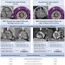 Neocommissural/Coronary Alignment With a Novel Balloon Expandable Transcatheter Aortic Valve: First-in-Human Experience