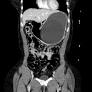 Gastric outlet obstruction due to an intragastric balloon in a patient returning from the Caribbean
