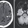 Case 19-2025: A 69-Year-Old Man with Headache and Ataxia